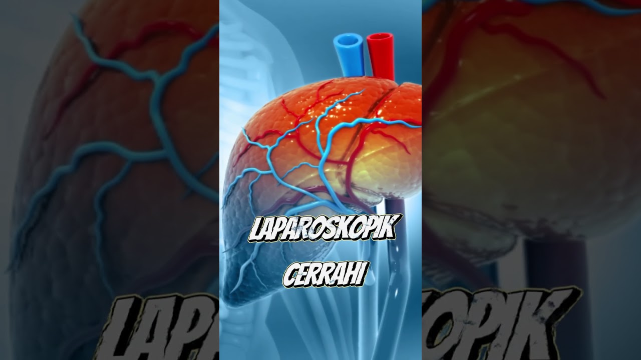 Laparoskopik Safra Kesesi Ameliyatı Nasıl Yapılır? | Do&ccedil;. Dr. Elbrus Zarbaliyev