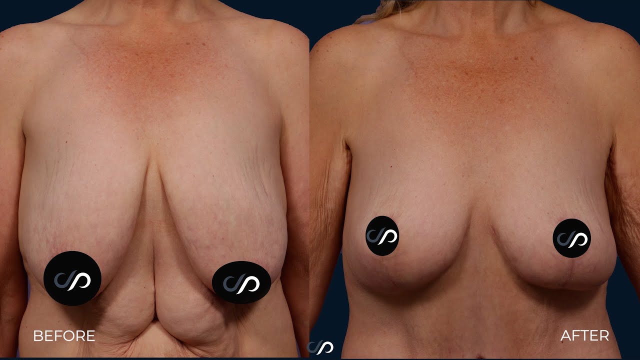 Breast Lift After Weightloss | Los Angeles | Dr. David Stoker