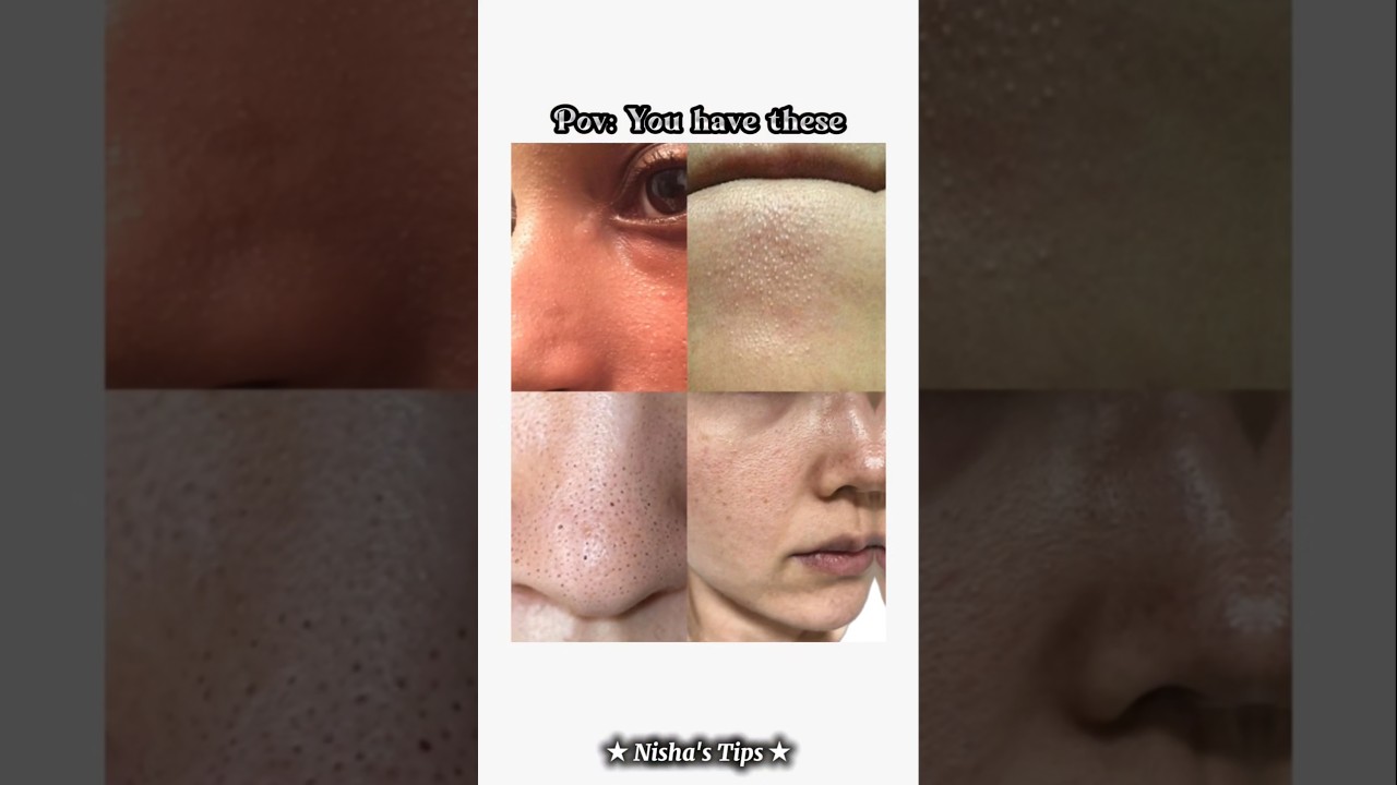 Blackheads? Clogged pores?Tiny bumps? Whiteheads?🎀 #shorts #aesthetic #skincare #fyp #trending #tips