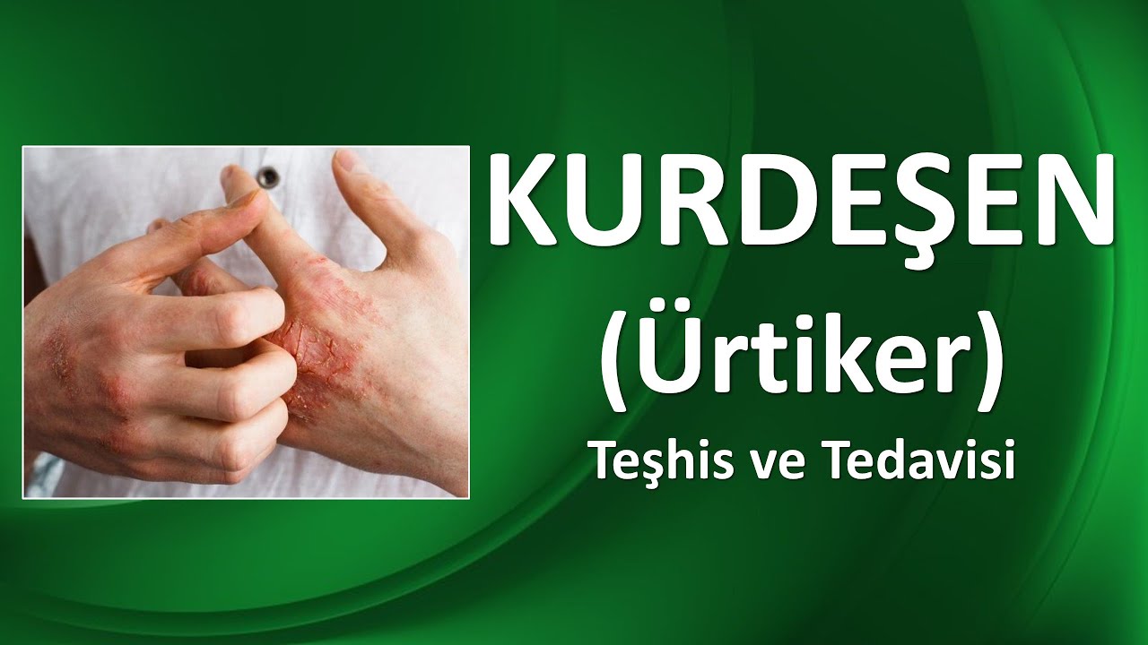 KURDEŞEN-ÜRTİKER NEDİR? Nasıl tedavi edilir?