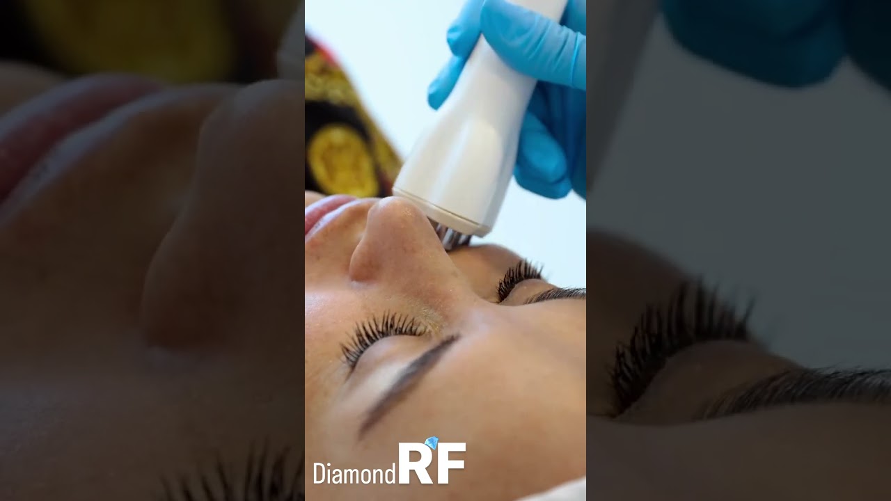 Unlock Radiant Skin with RF Diamond Treatment at EDEN AESTHETICS Clinic, Dubai
