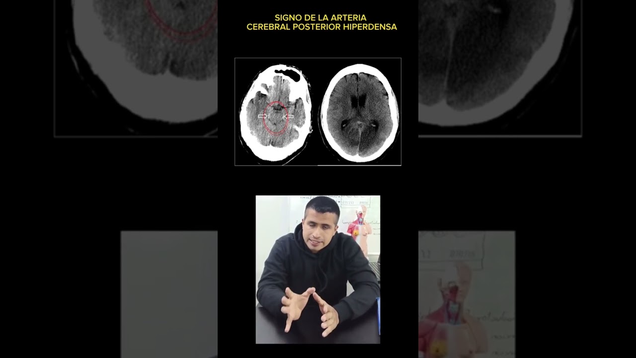 Signo de la arteria cerebral posterior hiperdensa