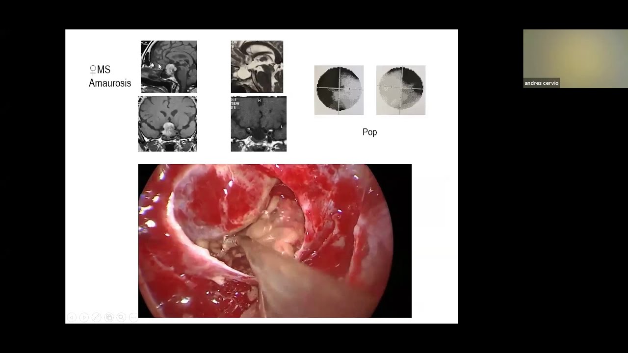 Cirug&iacute;a de las lesiones adenomatosas de la regi&oacute;n selar.  Dr. Andres Cervio