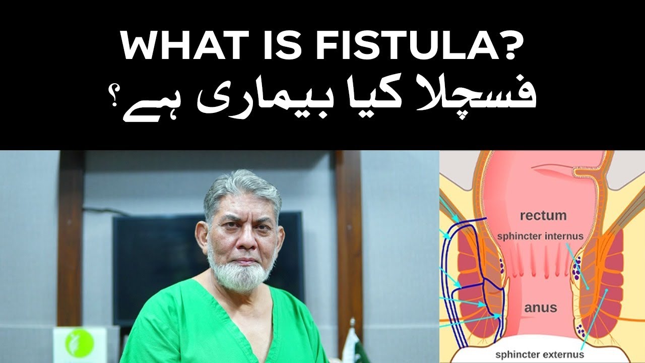 What is Fistula? Information for a common man