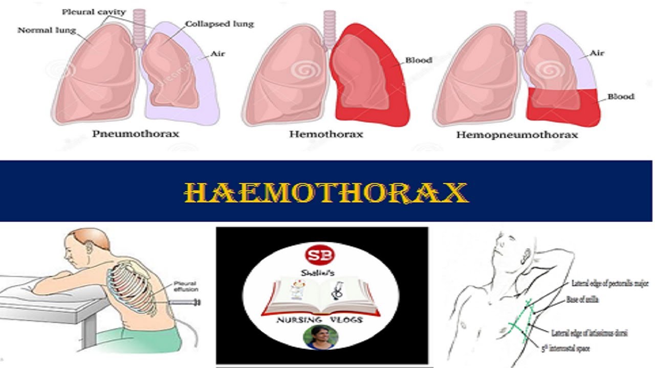 HAEMOTHORAX- Definition, causes, pathology, clinical manifestations, medical and nursing management