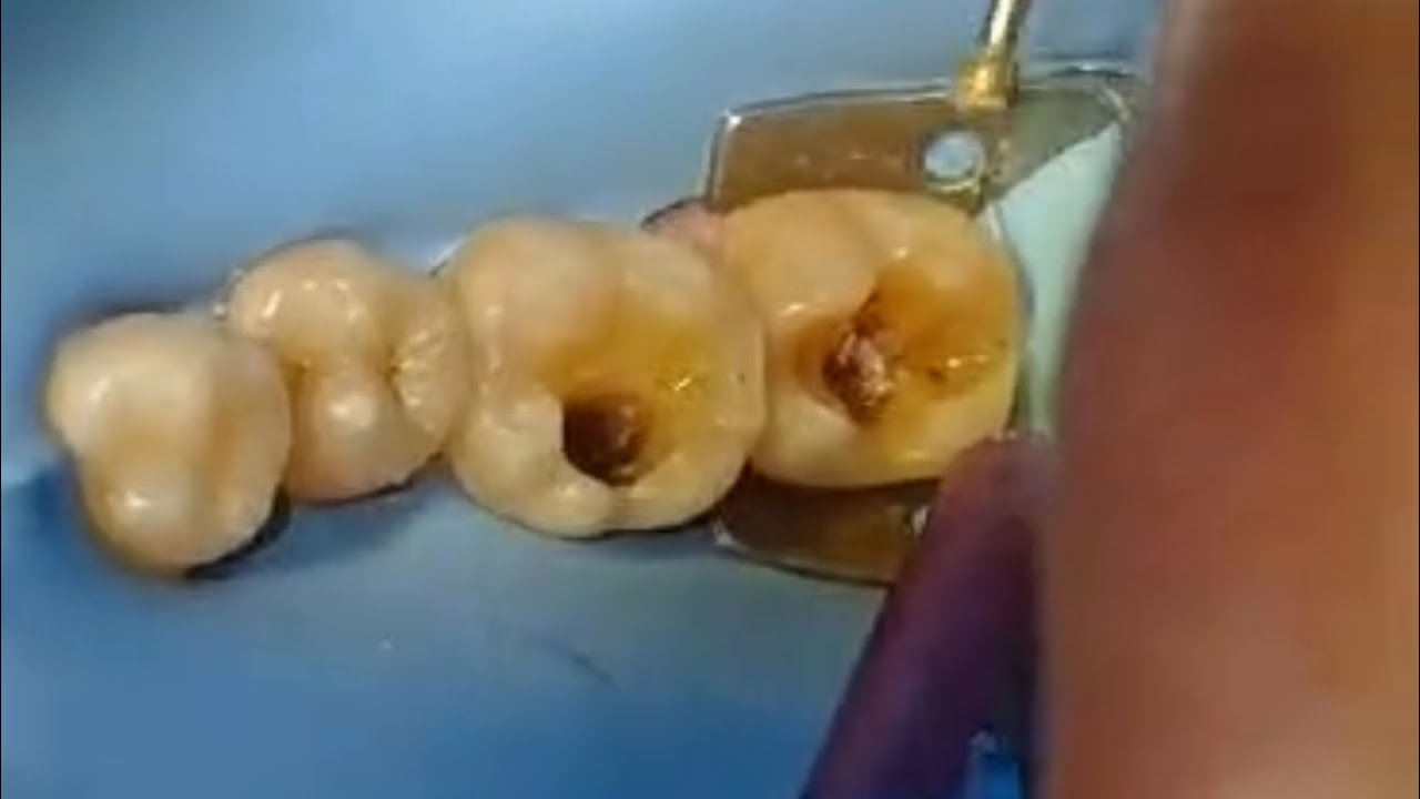 علامات تخبرك ان التسوس وصل لعصب السن او الضرس✅🦷درجات الم الأسنان وتشخيصه 