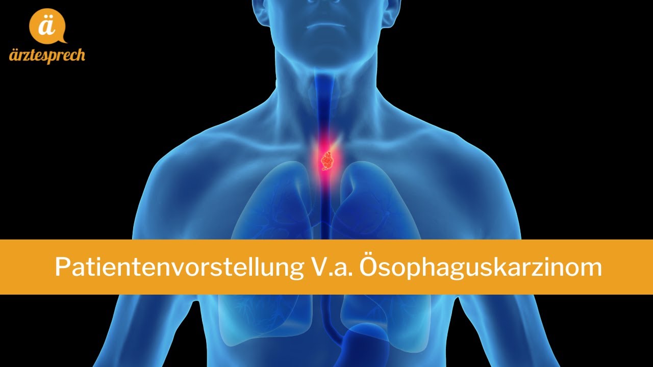 FSP Patientenvorstellung Ösophaguskarzinom