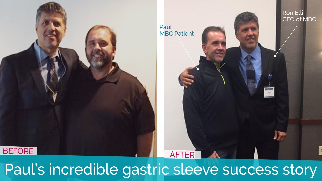 Paul's Gastric Sleeve Story | The Most Emotional Gastric Sleeve Transformation
