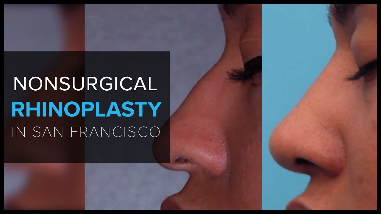 Non Surgical Rhinoplasty (