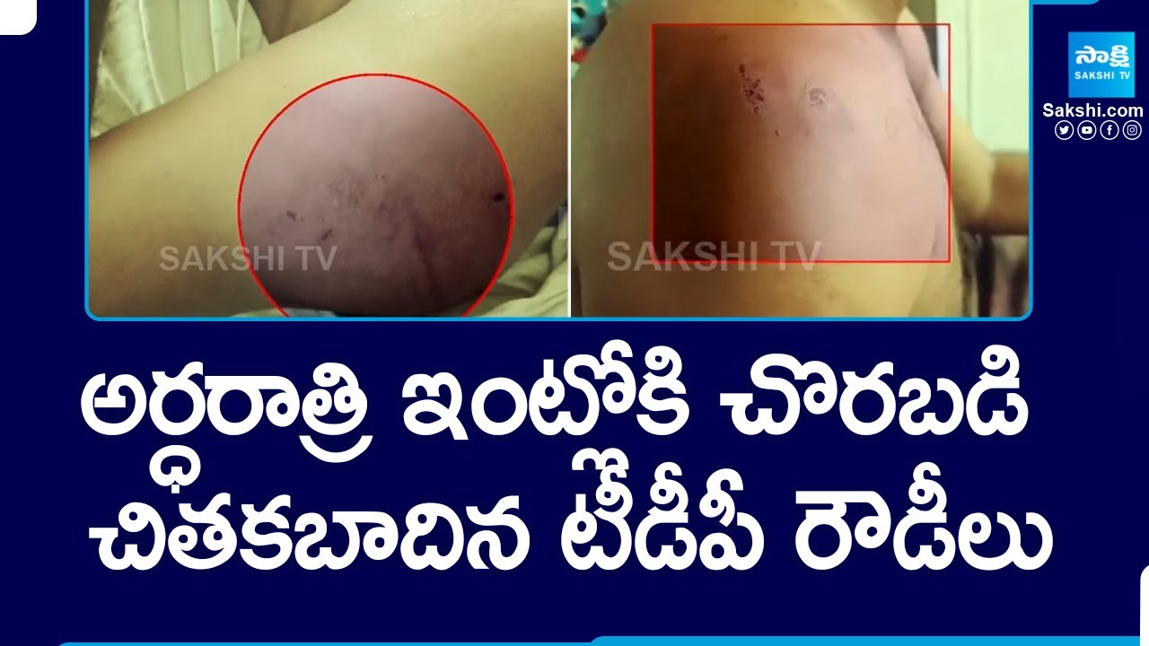 TDP Leaders Attack On Palnadu YSRCP Activist Dattatreya Nayak | Save From TDP Goons |