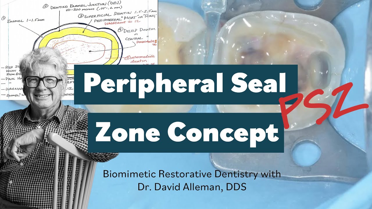 Peripheral Seal Zone Concept (PSZ) in Biomimetic Restorative Dentistry