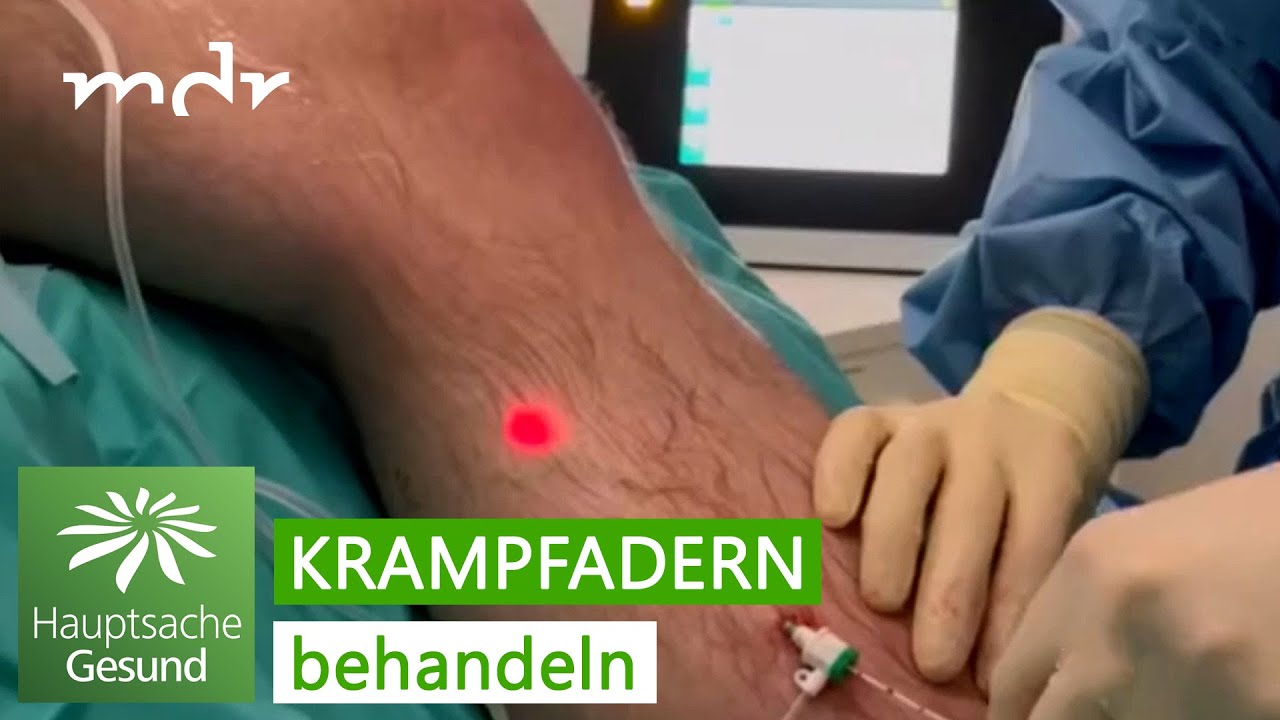 Neue Behandlungsmethoden bei Krampfadern &ndash; das ist state of the art | MDR