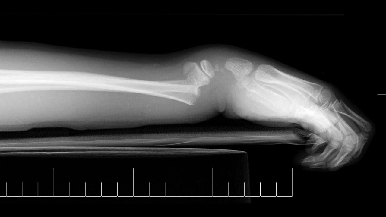 Exercícios para Extensão do Punho Fratura do Rádio Distal - Clínica de Fisioterapia Dr. Robson Sitta