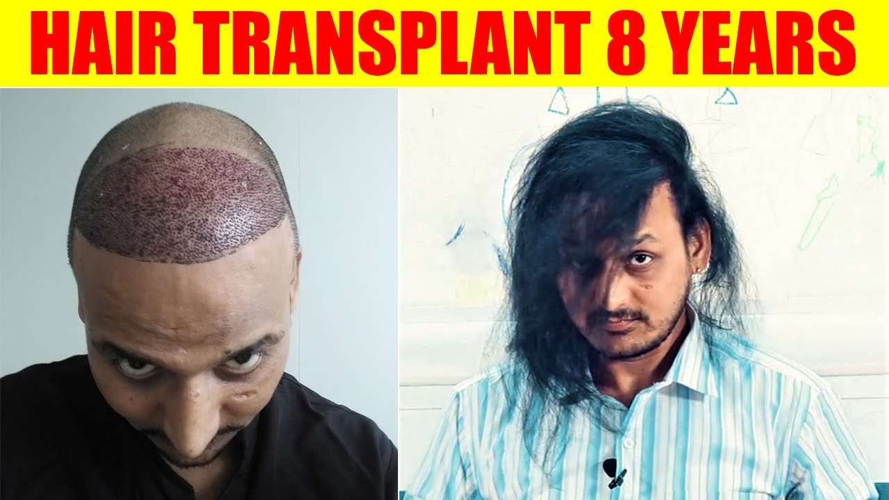 Hair Transplant Result After 8 Years | Honest Review & Reality