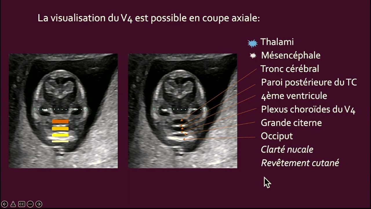 Pourquoi regarder le rachis au 1er trimestre (R.Mangione)