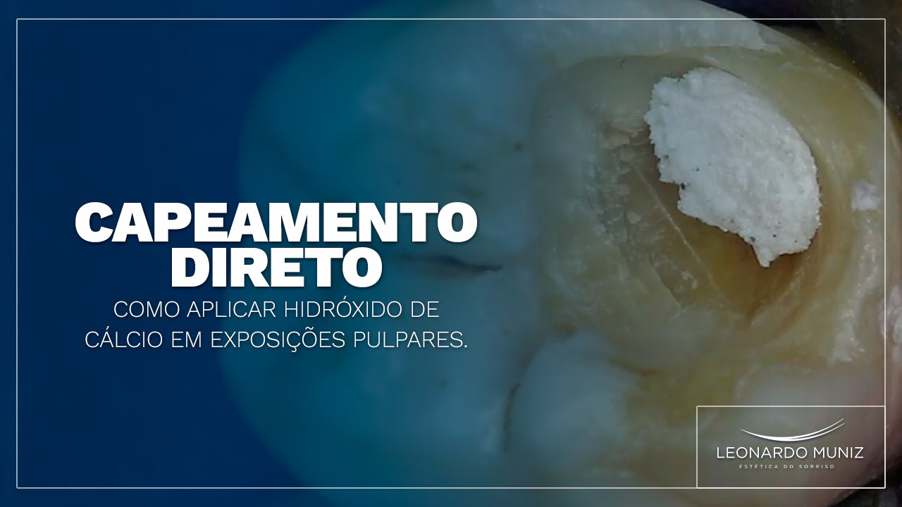 Capeamento Direto: Como Aplicar Hidróxido de Cálcio em Exposições Pulpares.