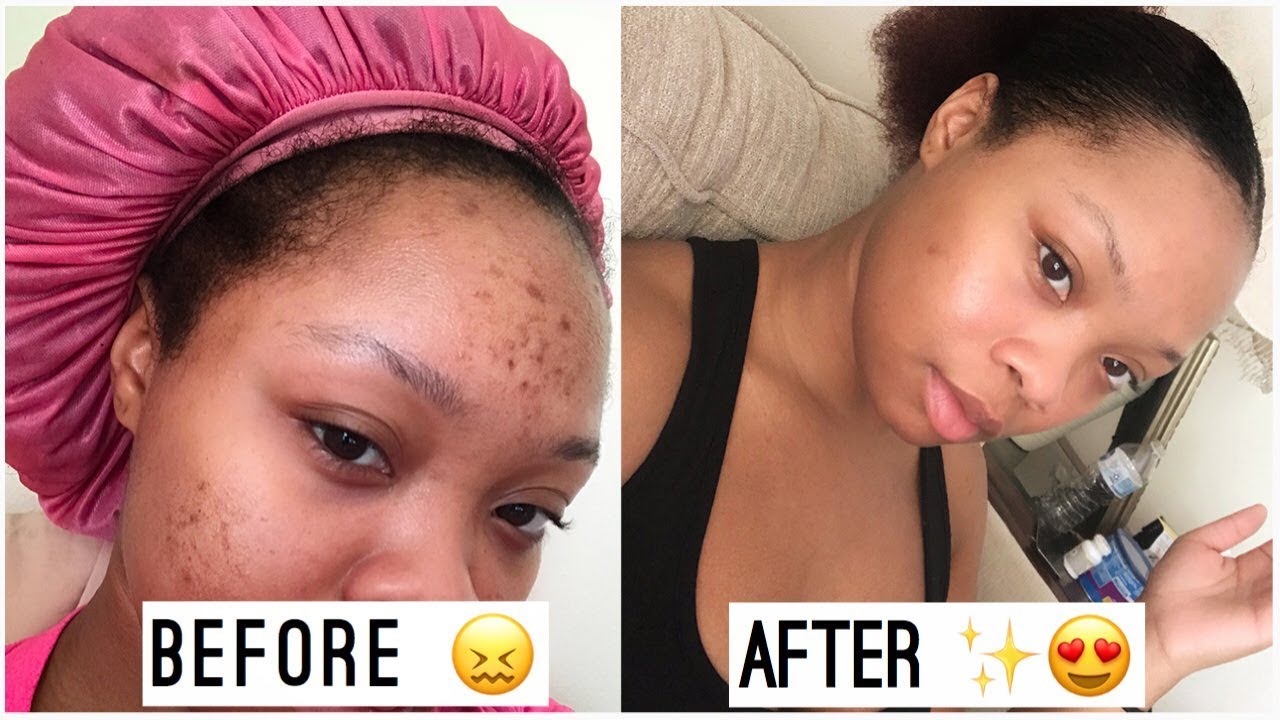 I Got Rid of My Dark Spots In less than a WEEK!!!