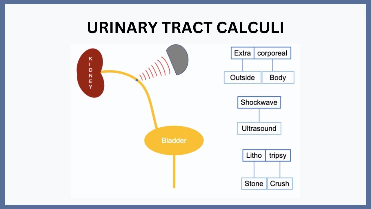 Urinary Tract Calculi Explained