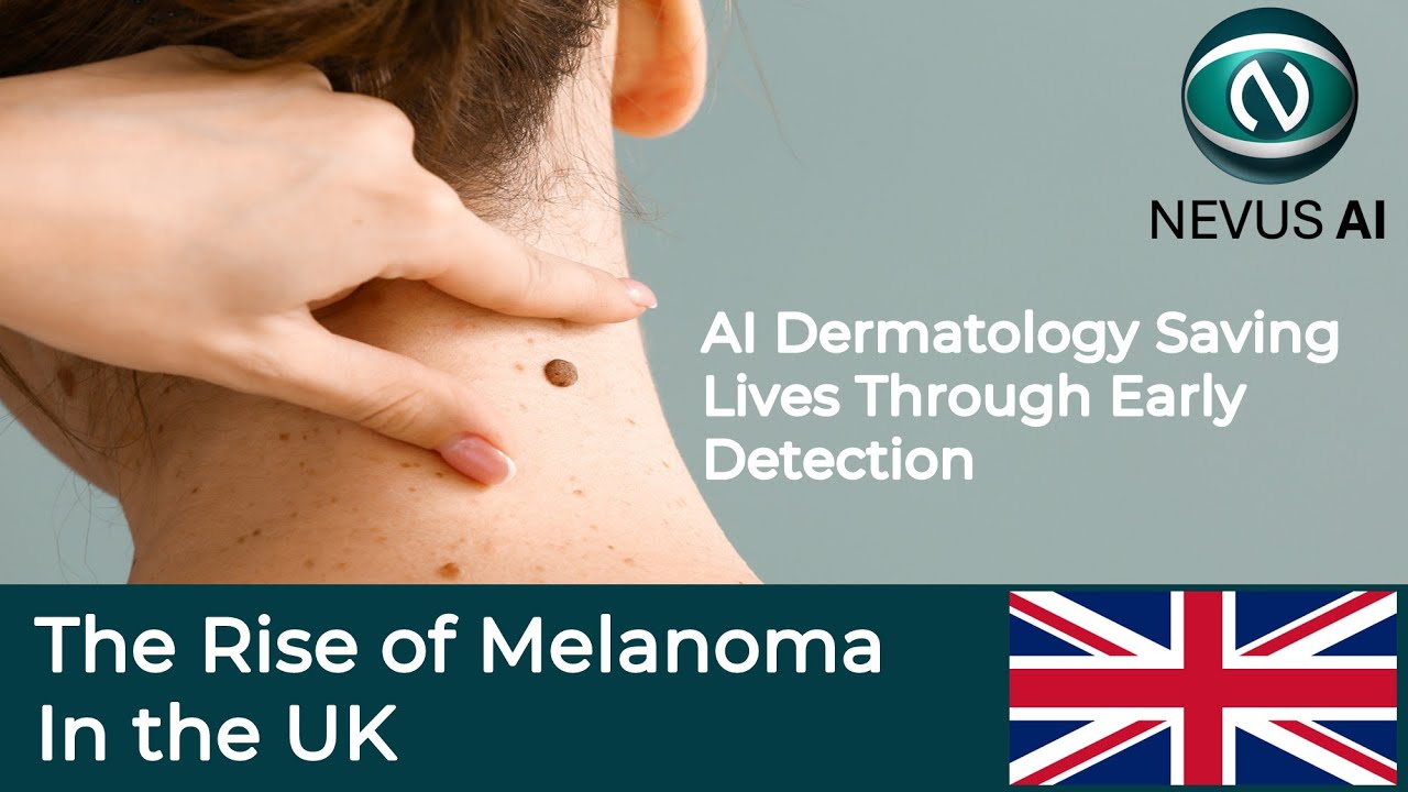 The Rise of Melanoma Skin Cancer In The UK & AI Dermatology