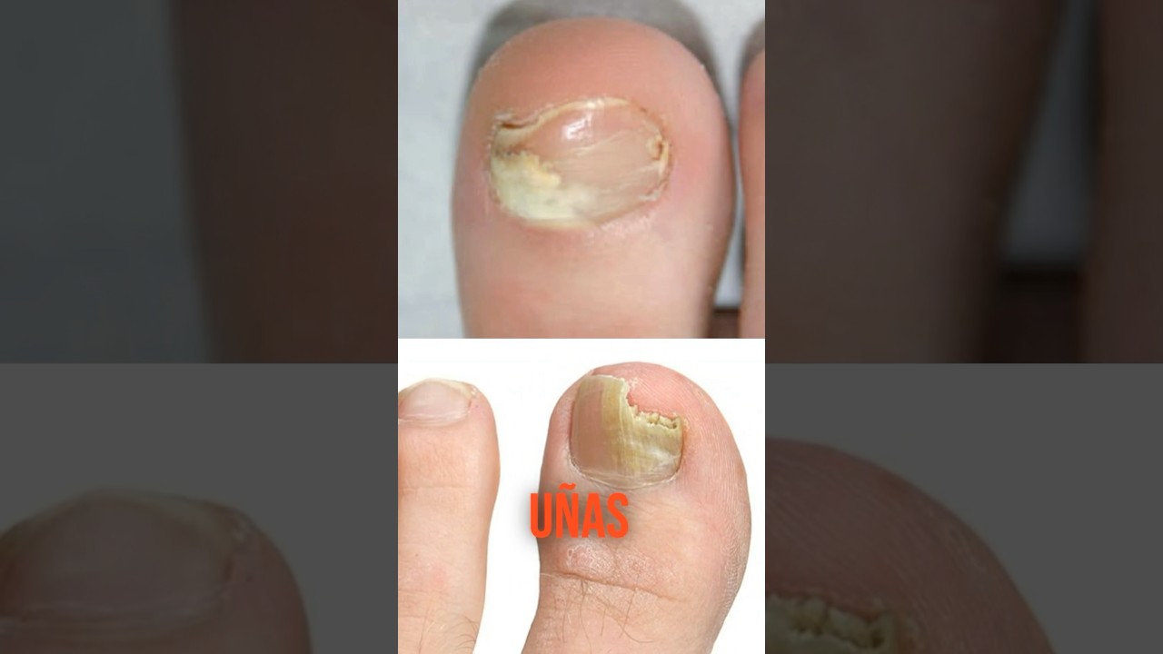 As&iacute; debes tratar los hongos en las u&ntilde;as de los pies 🦶 #onicomicosis #u&ntilde;as  #hongo #tratamiento