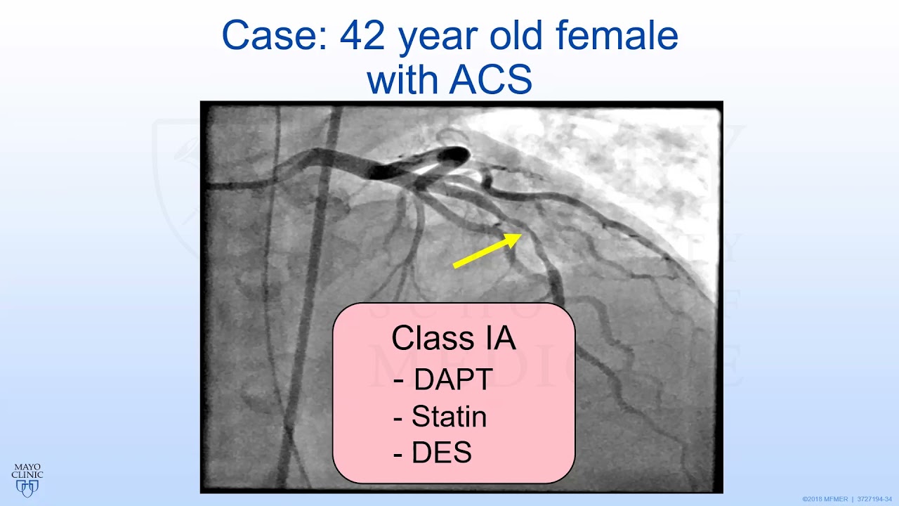 Diagnosis and Management Challenges in Spontaneous Coronary Artery Dissection
