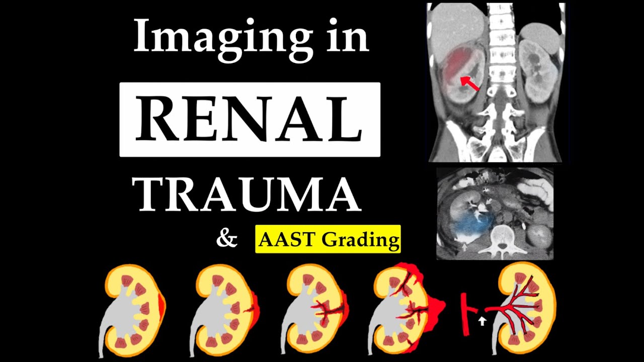 Imaging in RENAL TRAUMA & AAST grading l Recent updates l USG FAST l CECT l Angiography l