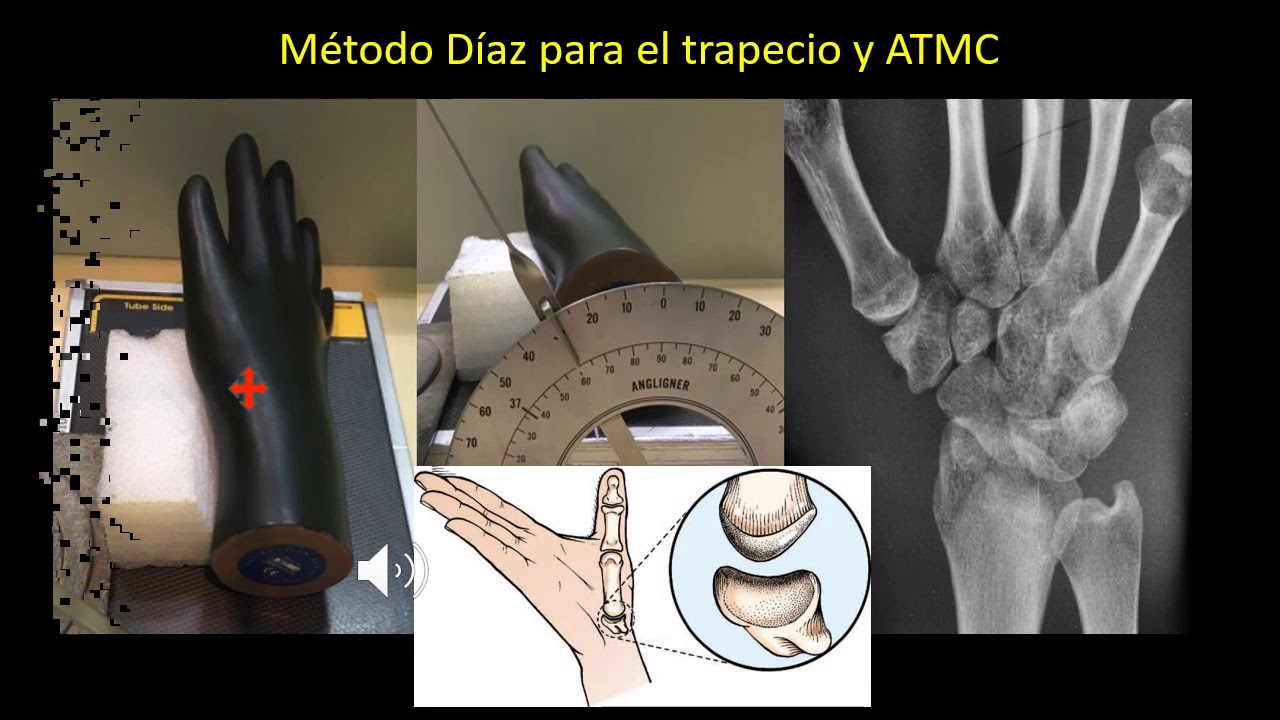 PROYECCIONES ESPECIALES DE LA EXTREMIDAD SUPERIOR / Lic Mario D Diaz Martínez - CHILE