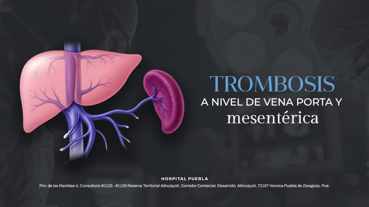 Trombosis a nivel de la vena porta y mesentérica.