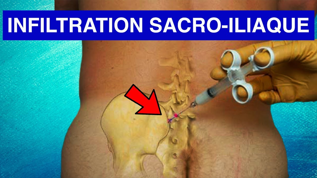 Infiltration sacro-iliaque
