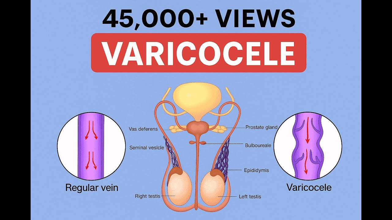 வேரிக்கோஸீல் (Varicocele) or விதை நரம்பு வீக்கத்தை குணமாக்குவது எப்படி?-Dr. Raguram MBBS, MS, MRCS