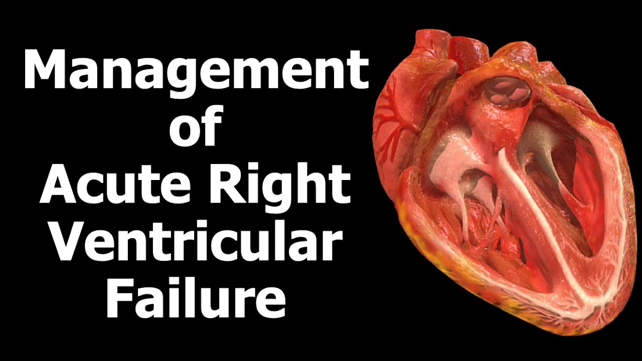 Management of Acute Right Ventricular Failure