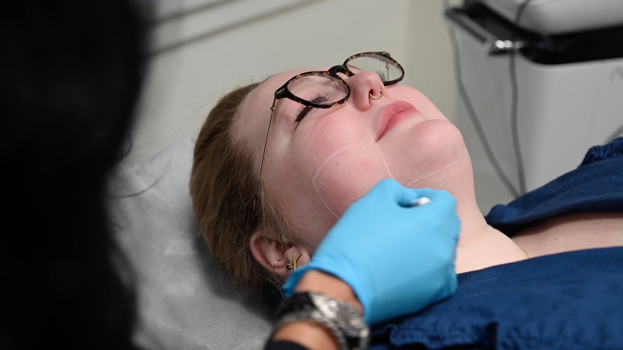 What is Agnes RF Microneedling