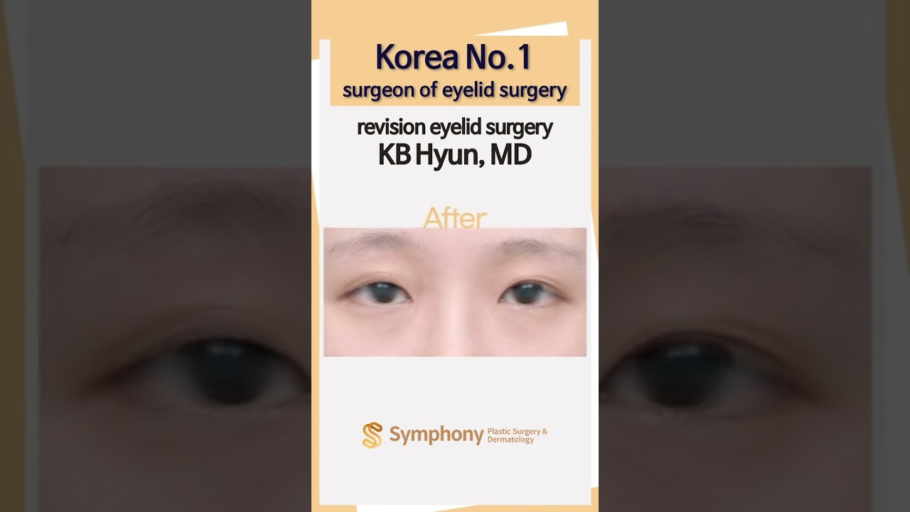 Korean eyelid revision surgery before and after pictures, Korean No.1 surgeon's techique!! #shorts