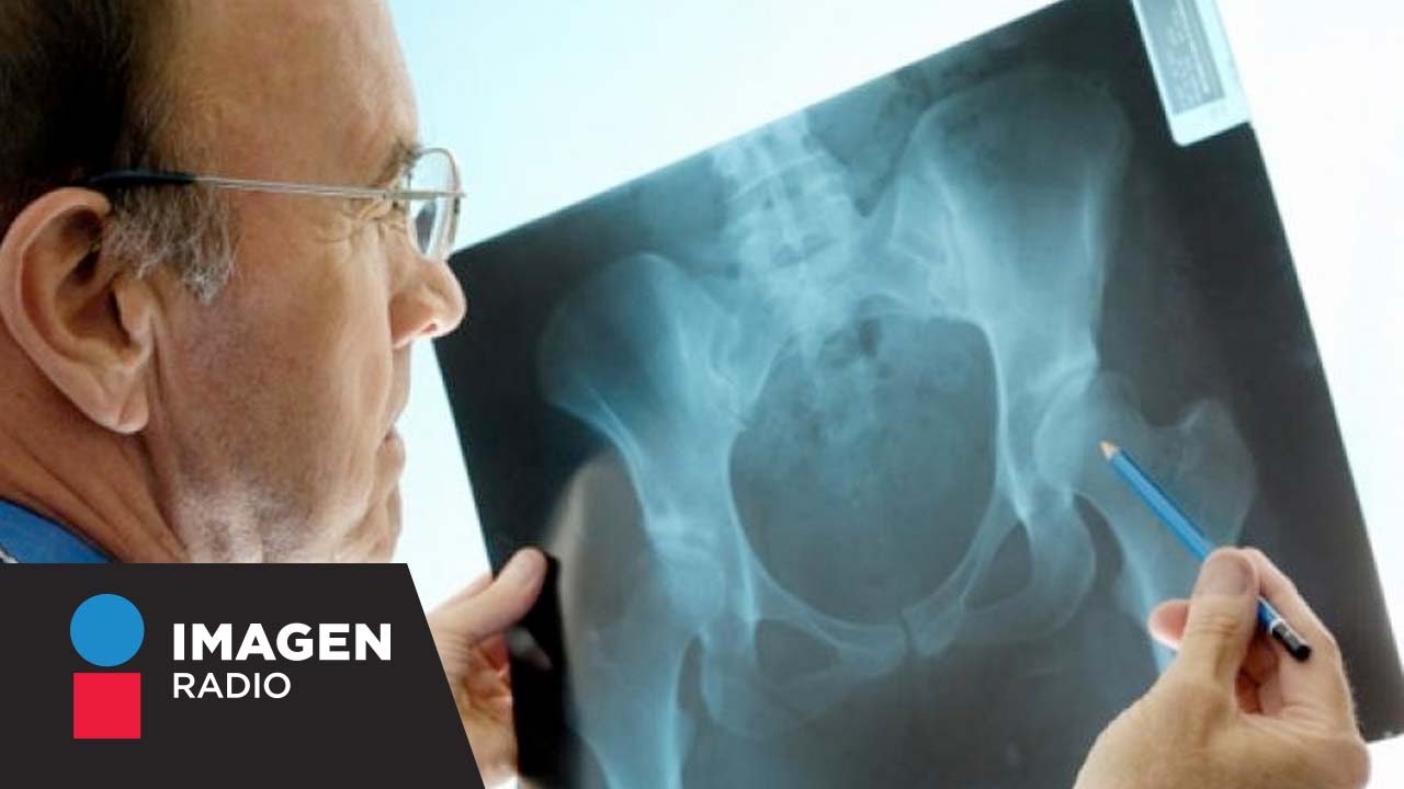Fractura de cadera: Manejo y tratamiento / Bien y Saludable