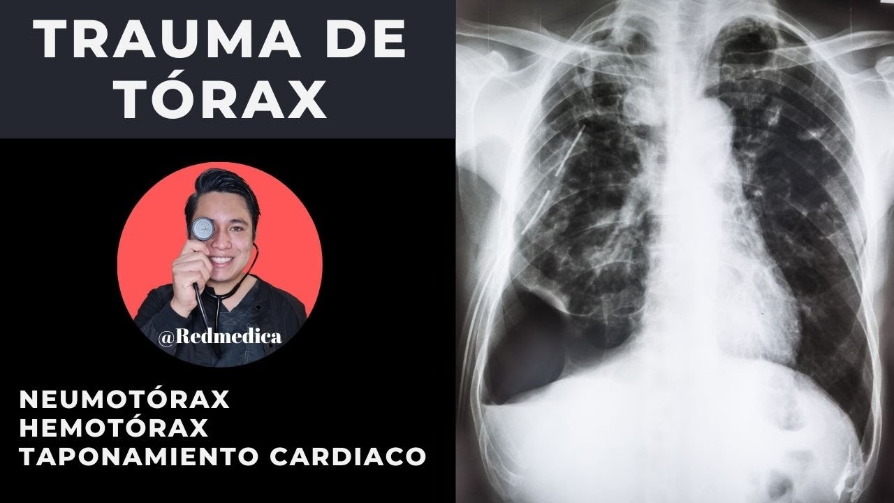 ATLS | Trauma de tórax | #ENARM2021 | 🩺Dr. Treviño