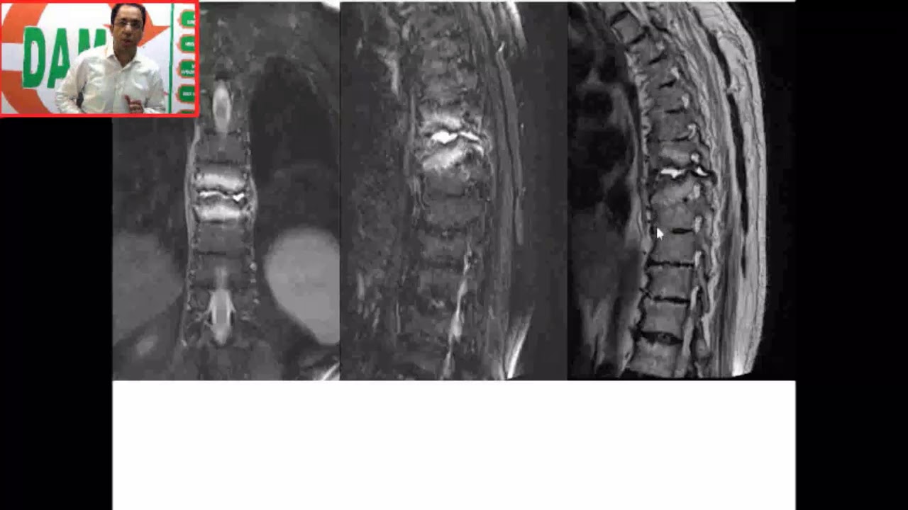 #DAMS #Unplugged #Ankylosing #Spondylitis #Complication