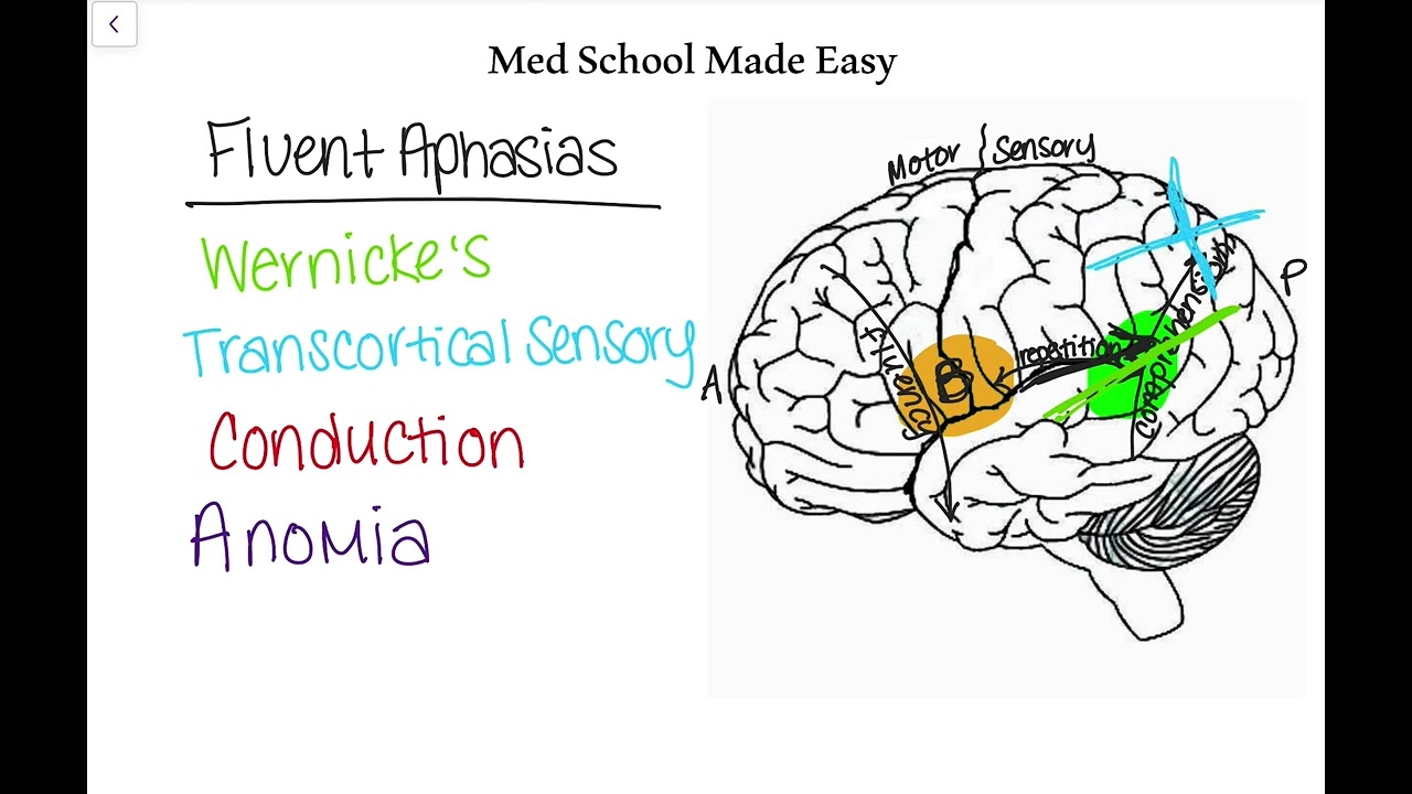 Fluent Aphasias Made Easy: How to Distinguish and Remember Them!