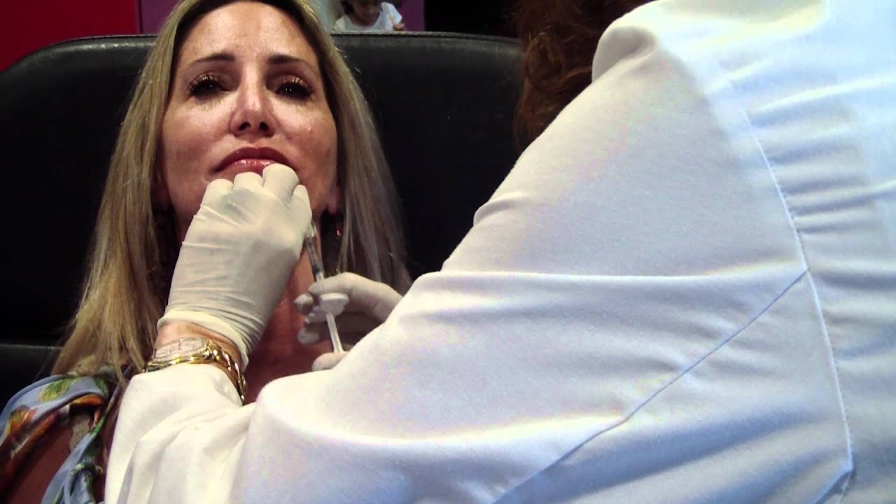 West Palm Beach Belotero Dermal Filler Wrinkle Treatment