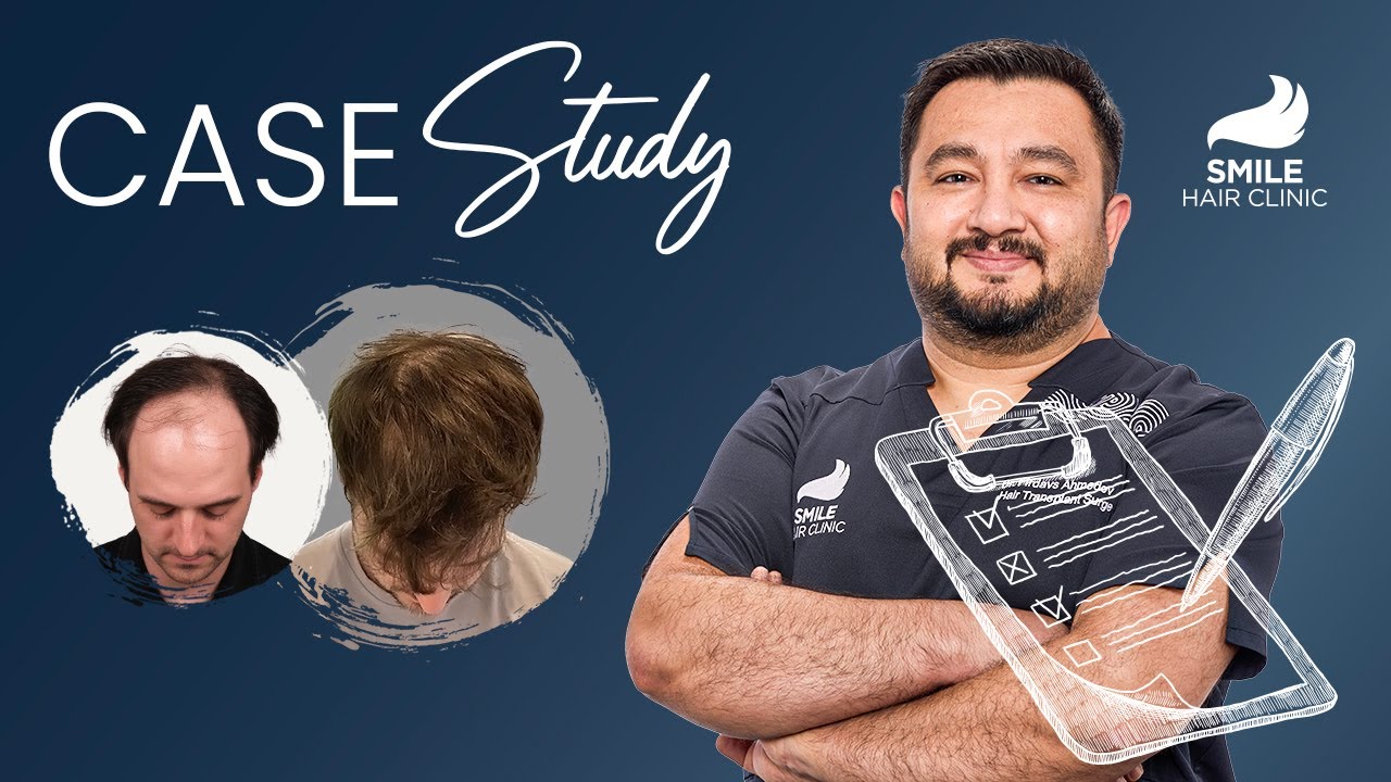 Case Study: 4750 Grafts Hair Transformation with Dr. Ahmedov | 12-Month Results - Hair Transplant