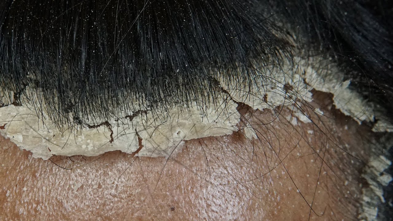 Ultimate Scalp Cleaning: Combing  with Black Comb Away Dandruff #DKMO3026