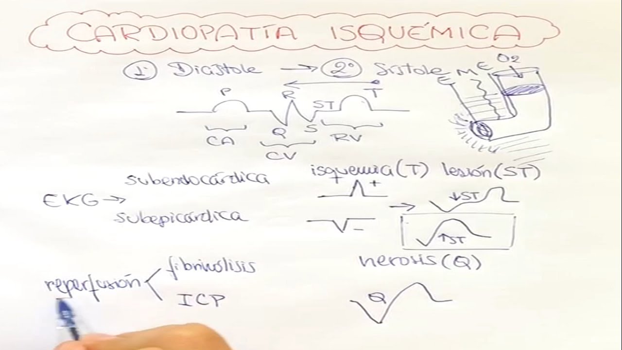 Cardiopatía isquémica (2): alteraciones en el EKG frente a un SCA: T, ST, Q, derivadas del corazón