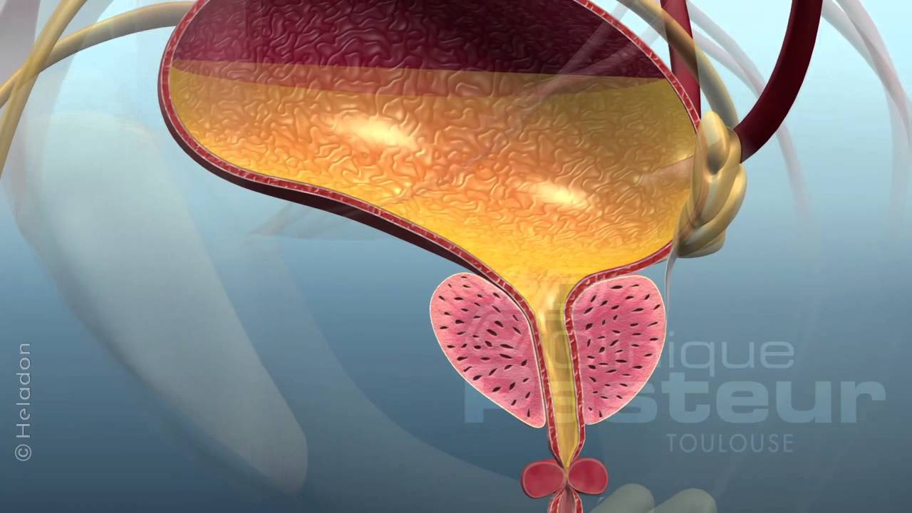 Urologie - Adenome de la prostate - Traitement médical
