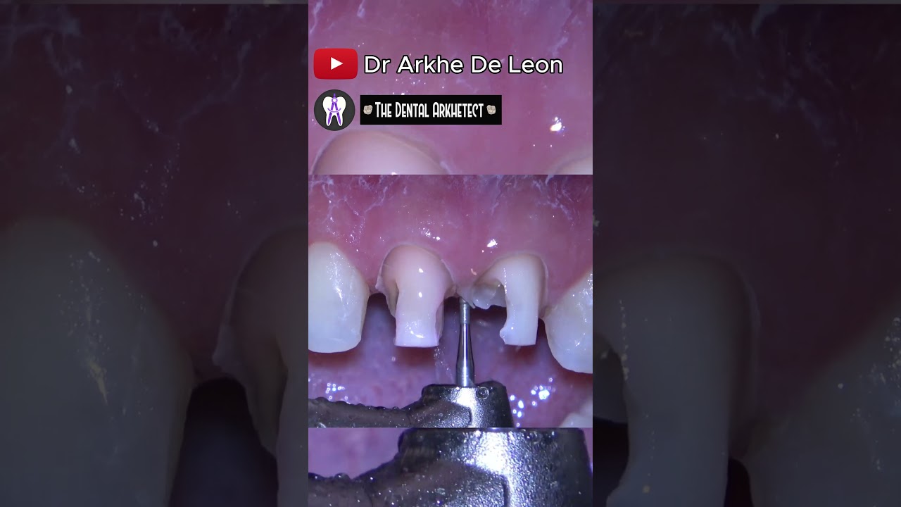 Heavily Damaged Teeth Restored with Zirconia Crown (Part 1)#4k
