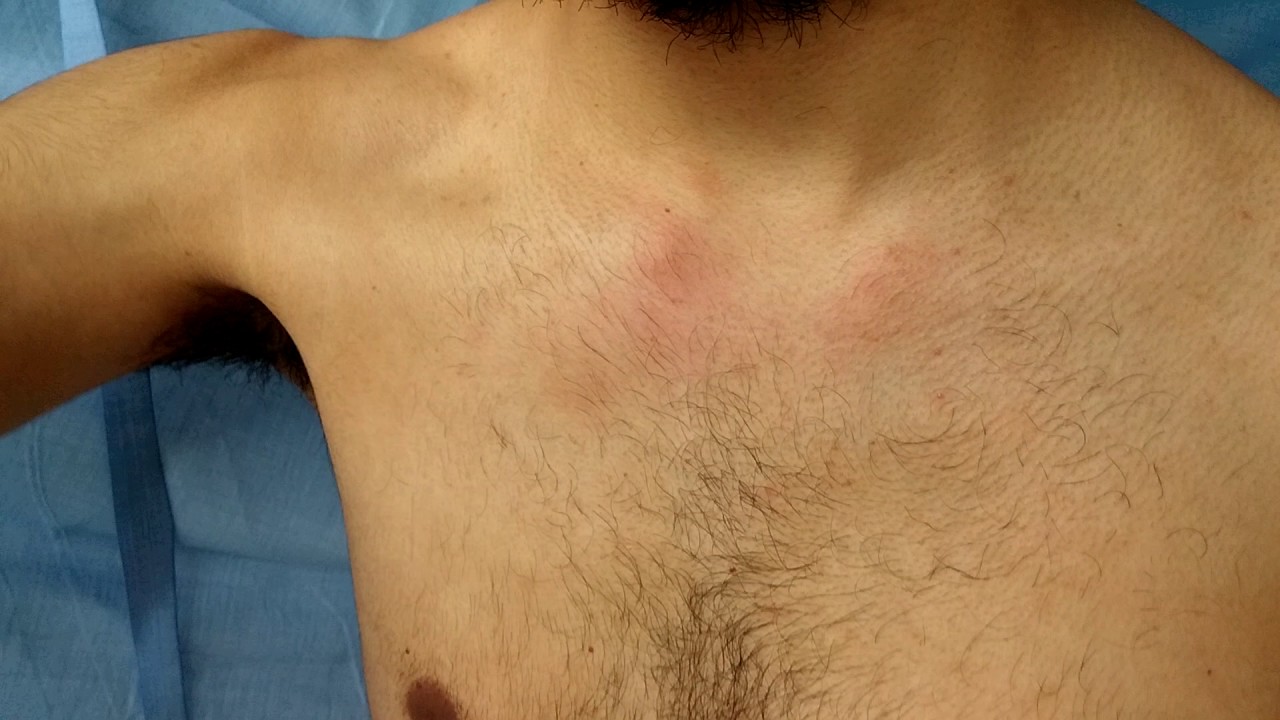 Inestabilidad EsternoClavicular