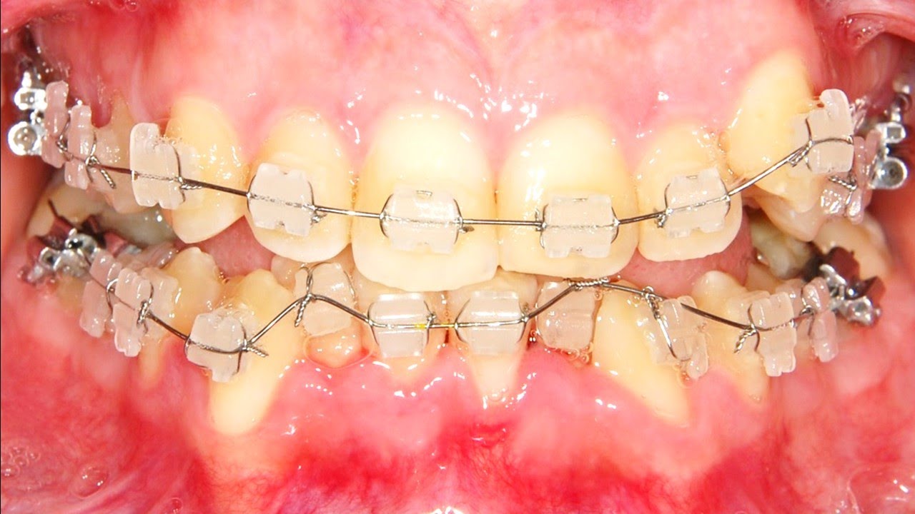 ¿ Como  soluciona la Ortodoncia los dientes torcidos mediante la alineación y nivelacion? 😎🦷