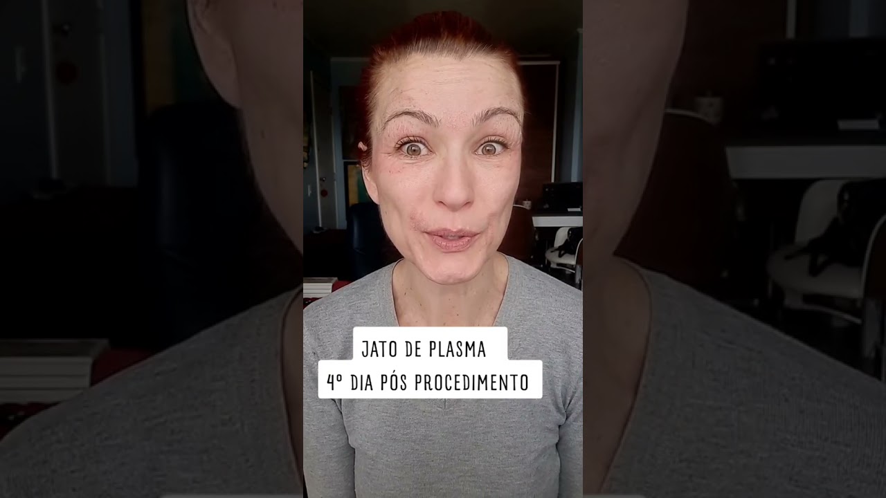 JATO DE PLASMA - 4° DIA PÓS PROCEDIMENTO 