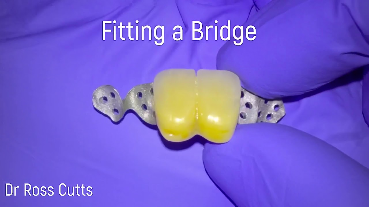 Fitting an Adhesive Bridge