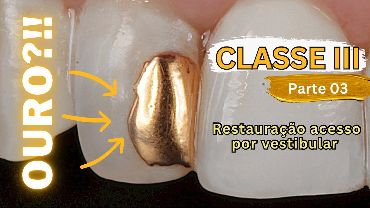 Restauração Classe III - Parte 03 - Acesso Vestibular