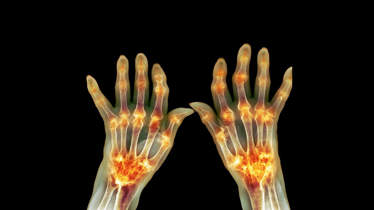 Understanding Rheumatoid Arthritis: Diagnosis & Management