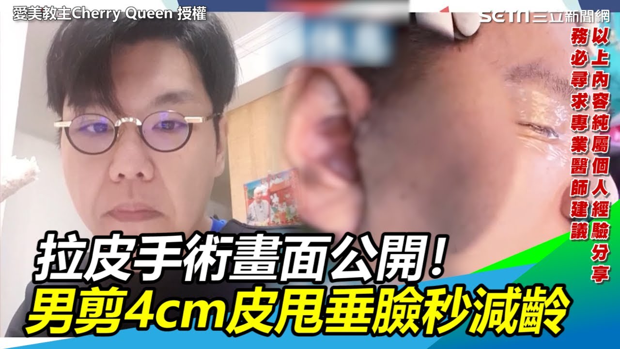 拉皮手術畫面公開！男剪4cm皮甩垂臉秒減齡｜三立新聞網SETN.com